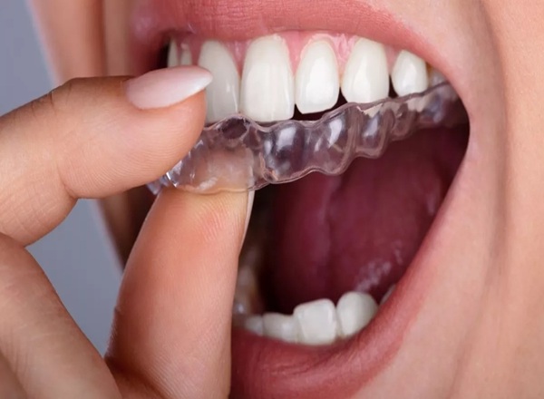 Invisalign alineadores transparentes
